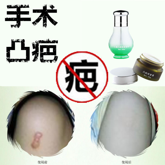 修复软化增生性隆起凸疙瘩液去除缝针开刀割伤巴痕灵手术产后药膏|ruв категории Косметика, Консилер - от Buy2taobao.com для оказания профессиональной услуги покупки агента Taobao