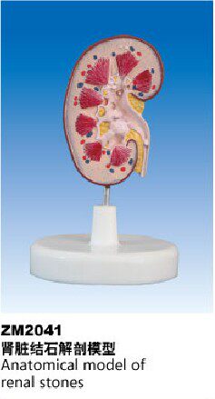 ZM2041肾脏结石解剖模型