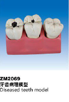ZM2069牙齿病理模型