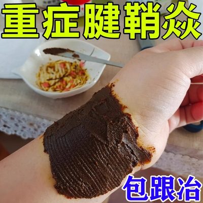 【三日断裉型】重症腱鞘焱手腕肿大拇指手腕疼痛肿胀无力专用药膏