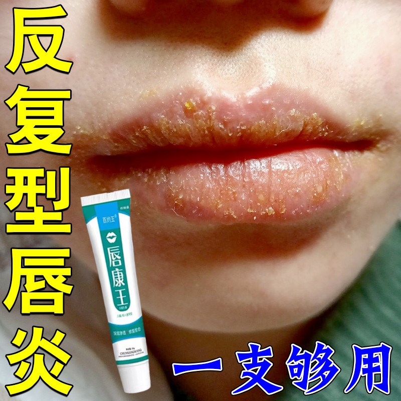 唇炎专用唇膏嘴唇干燥起皮刺痛红肿烂嘴角口角炎干裂脱皮滋润唇膏