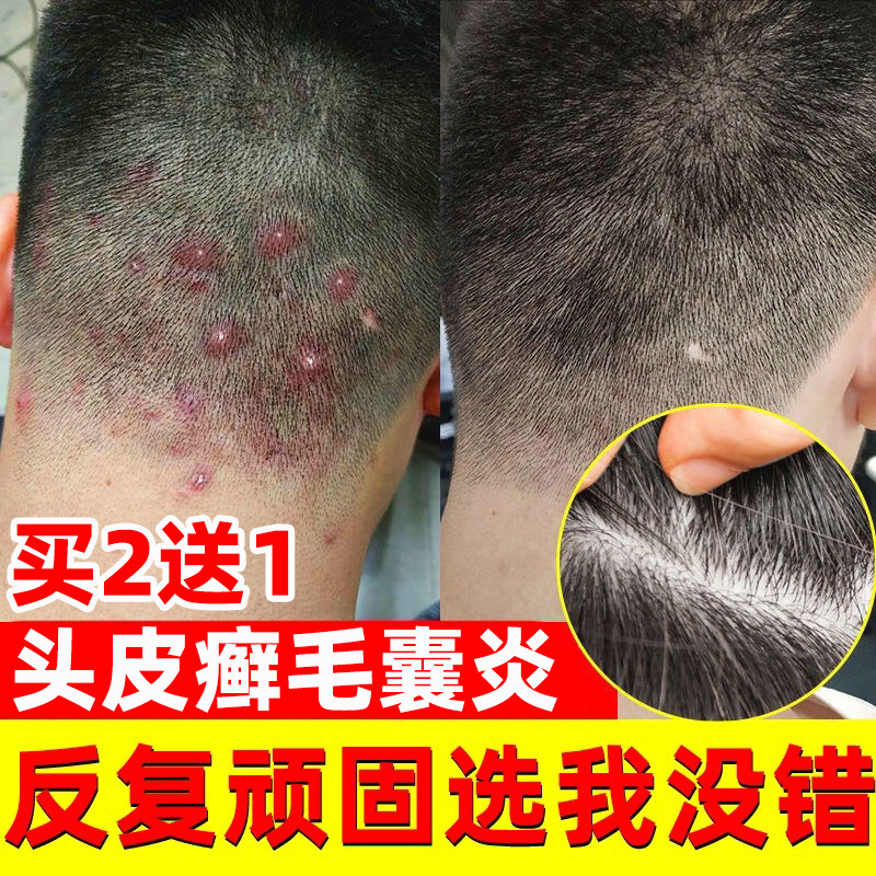 去头藓药膏治鲜药牛皮癣头皮真菌感染喷雾癣克星头皮癣专用药膏