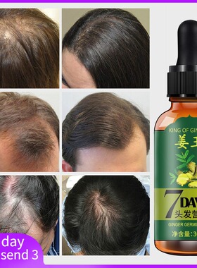 Hair Loss Treatment Ginger Growth Essence Oil老姜头发养护油