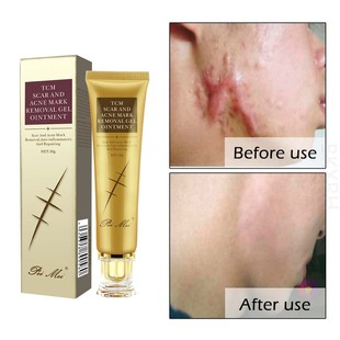peimei 修复膏 Acne scars remove acne Remove scar cream