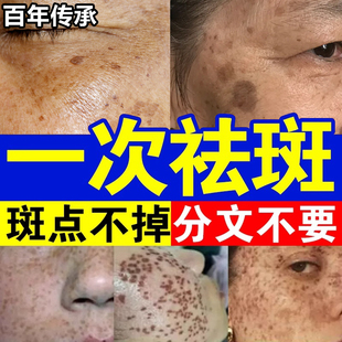 老年斑去除脸部手部去斑专用老人祛斑霜祛黄褐斑雀斑官方正品