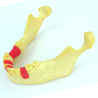 ENOVO颐诺口腔种植齿科培训实训操作模型仿真下颌骨人工种植缺失