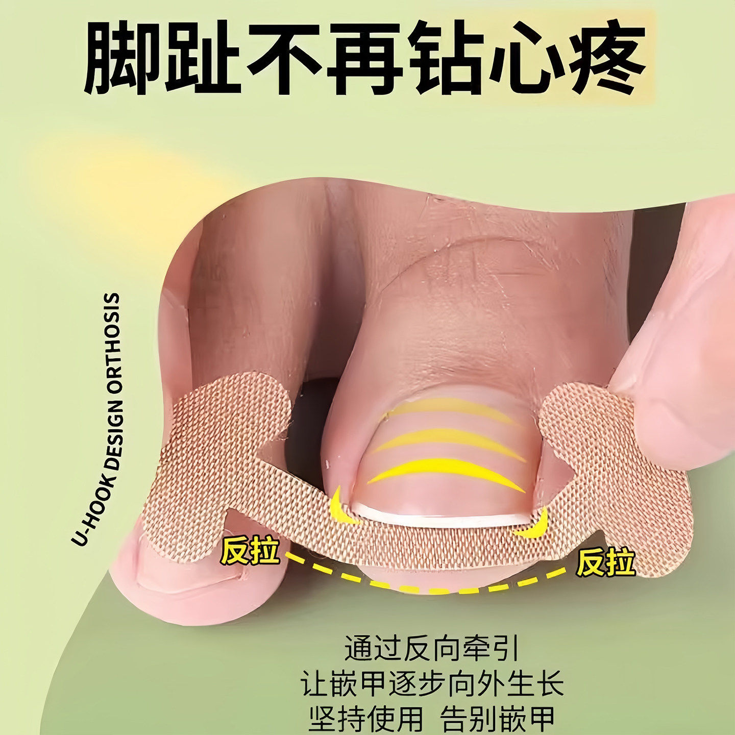 甲沟神器指甲矫正器隔离脚趾甲长肉里填充垫片纠正炎嵌甲专用拉贴