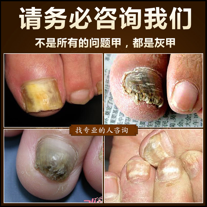 去灰甲专用液 软甲膏去除增厚灰医用用具