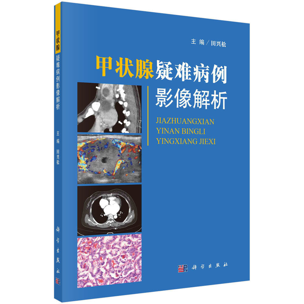 甲状腺疑难病例影像解析 田兴松 编 甲状腺恶性肿瘤 甲状腺转移性肿瘤 甲状腺超声 颈部CT 颈部MRI 甲状腺专科医师参考实用型书籍
