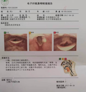 声带息接触性肉芽肿物肥厚小结囊肿咽干喉咙疼痛异物感声音嘶沙哑