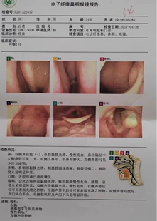 声带息接触性肉芽肿物小结肥厚声嘶沙哑咽痛发音费劲闭合不全炎