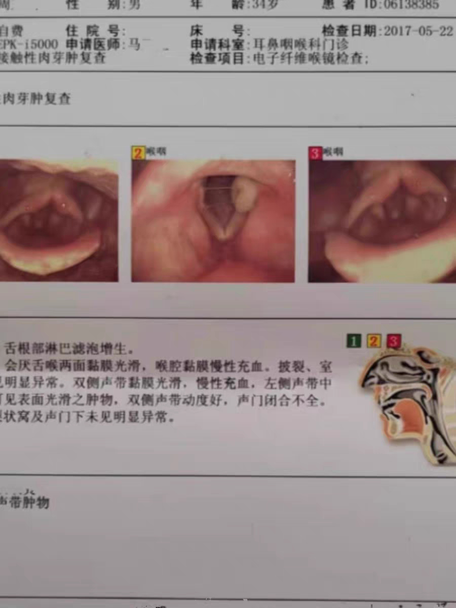 声带息肉接触性肉芽肿物小结肥厚声嘶沙哑咽痛发音费劲闭合不全炎