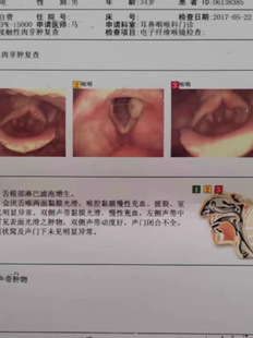声带息肉接触性肉芽肿物小结肥厚声嘶沙哑咽痛发音费劲闭合不全炎