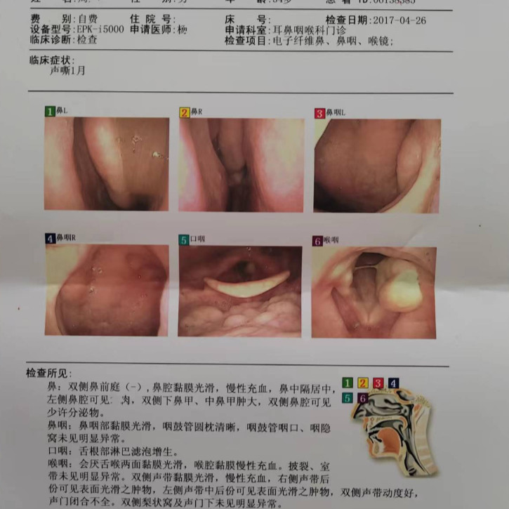 声带息接触性肉芽肿物小结肥厚任克氏水肿音嘶沙哑说话费劲异物感