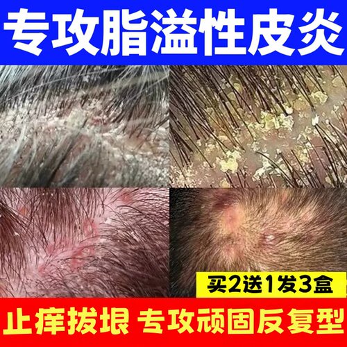 【包冶根】脂溢性皮炎头皮痒