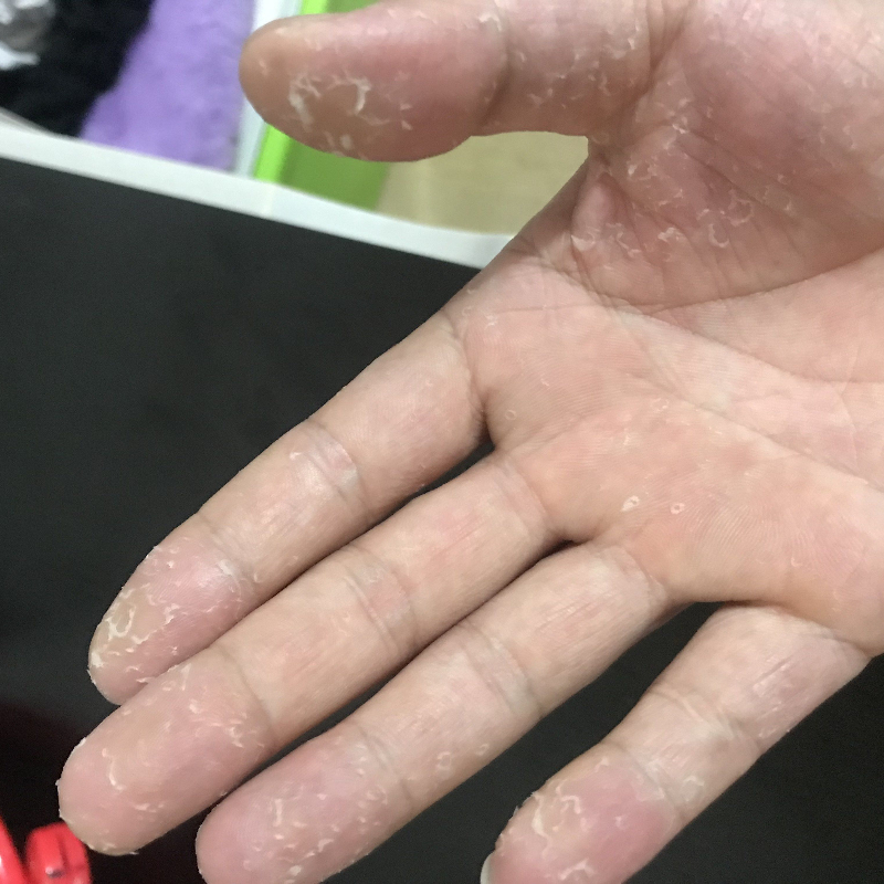 26手脱皮修复霜手掌手指蜕皮严重专用儿童护手蜕皮手足起皮掉皮膏