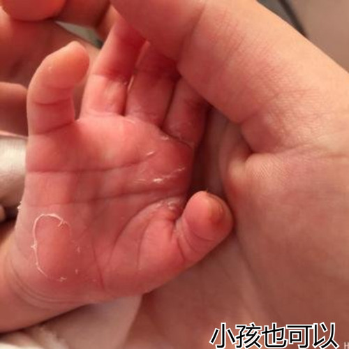 手痒起小水泡手气汗状疹专用软膏手上指手脚痒脱皮痒膏死皮脚痒