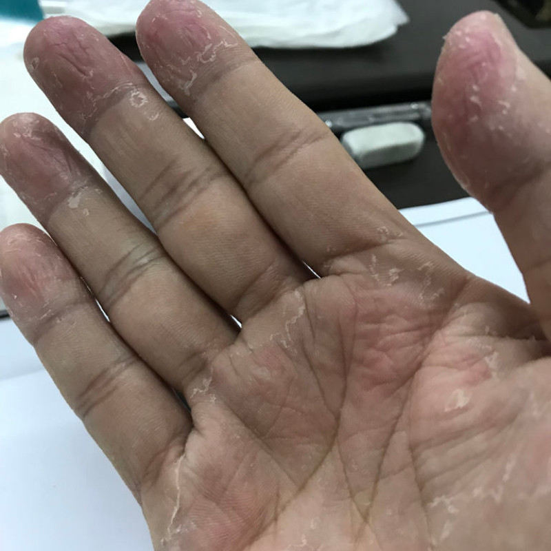 老卢头开裂节口季护指性