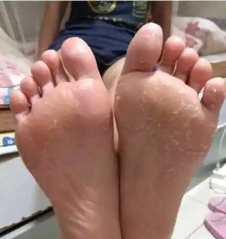 手脚开裂干裂干燥脱皮掉皮修复霜季节性手起水泡手部护理去死皮膏