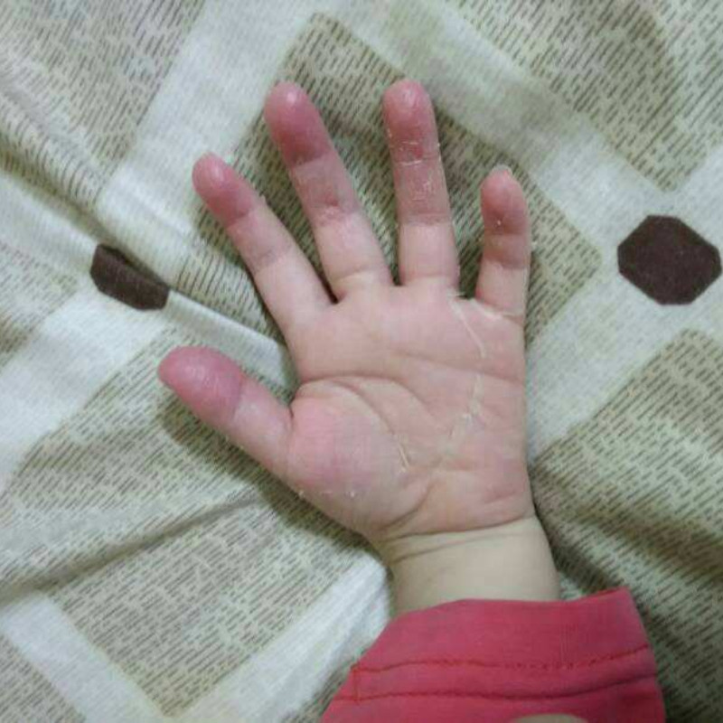 宝妈推荐儿童手掌蜕皮手脱皮膏手指头上起皮干燥爆皮手掌手脚掉皮