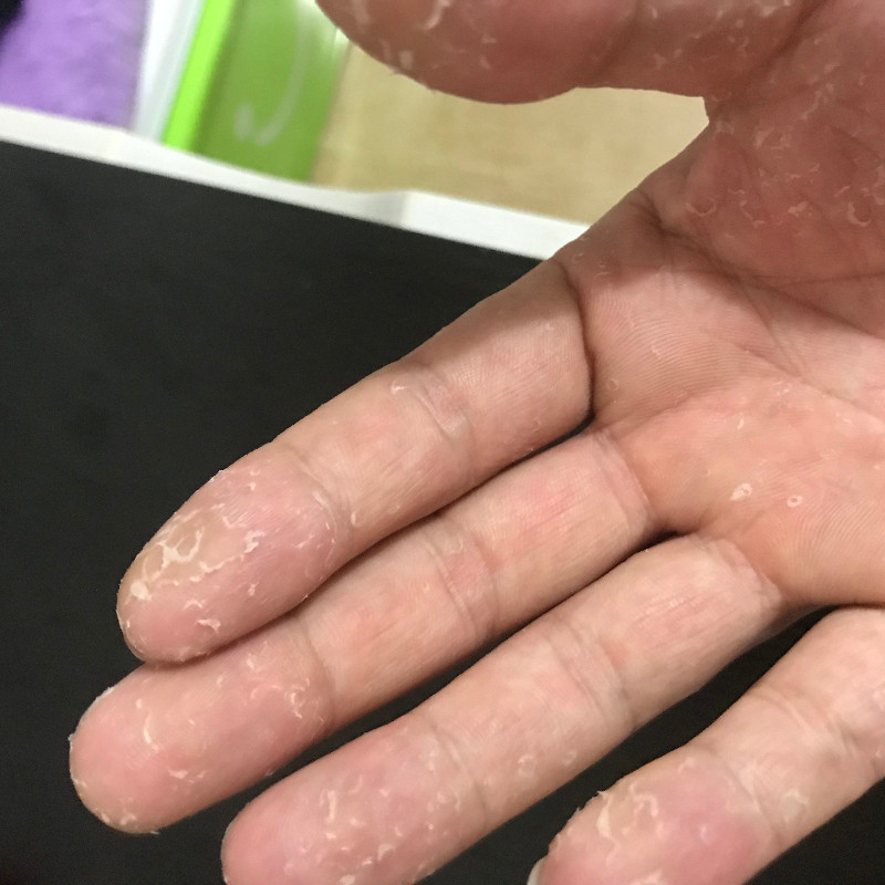 手上起小水泡药专用疱汗状疹专用软膏脱皮止痒真汉状菌感染手气膏