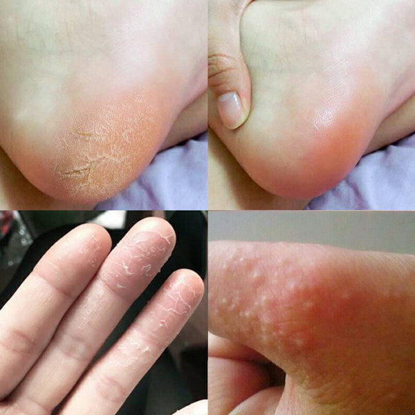 脚底上起小水泡又痒又脱皮烂脚丫干燥掉皮脚臭气出汗真菌感染专用