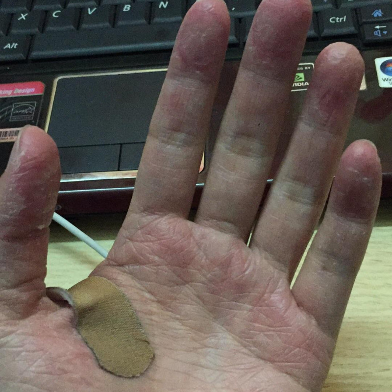 手上起小水泡手指出汗感染痒专用汉状真菌干裂疼痛脱皮疱汗疹软膏