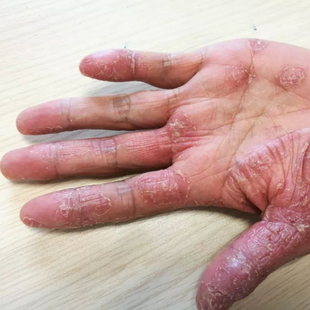 手痒起小水泡手气止痒脱皮杀菌手上长水泡手藓脱皮干裂汗疱颗疹膏