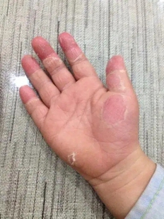 手痒水泡脱皮干开裂手气手上起小水泡手指头起皮干燥季节性脚底膏