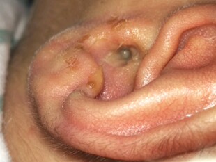 耳朵痒流脓水肿痛耳鸣中耳专用炎药滴耳液外耳道发炎抑菌止痒专用