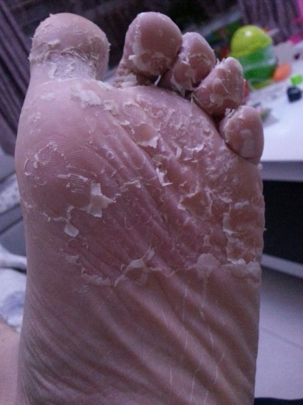 脚底板脚后跟脚痒气脱皮有脚上长水泡痒脚的烂脚丫水泡型专用