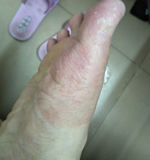 水疱脚底起水脱皮泡脚丫痒专用红痒手脱皮保湿舒缓修护软膏