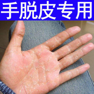 手脱皮裂开手脱皮严重治疗儿童手脱皮的药手脱皮剥脱性角质松懈症