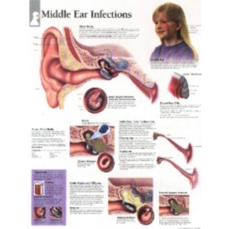 预订不退不换Middle Ear Infections Paper Poster[9781930633193]