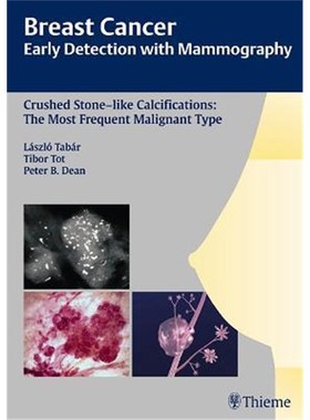预订Breast Cancer: Early Detection with Mammography:Crushed Stone-like Calcifications: The Most Frequent Malignant Type