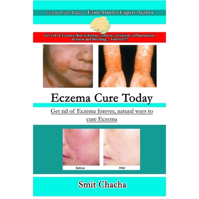 按需印刷Eczema Cure Today - Get rid of Eczema forever natural ways to cure Eczema[9781387307982]
