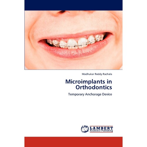 按需印刷不退不换Microimplants in Orthodontics[9783847312062]