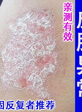 干裂腿部癣痒腿上脱皮身上长癣手臂皮肤干燥起皮治皮肤顽固乳膏癣