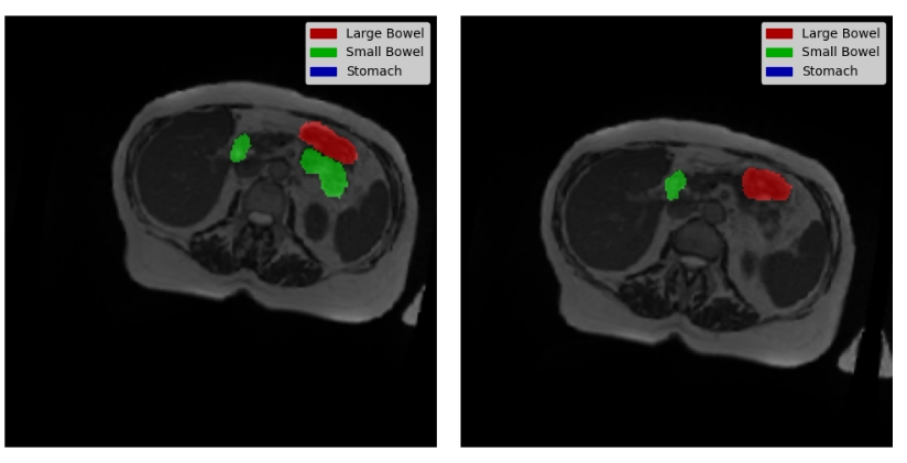 dl00372-基于深度学习unet医学病灶检测肠胃道图像分割含数据集
