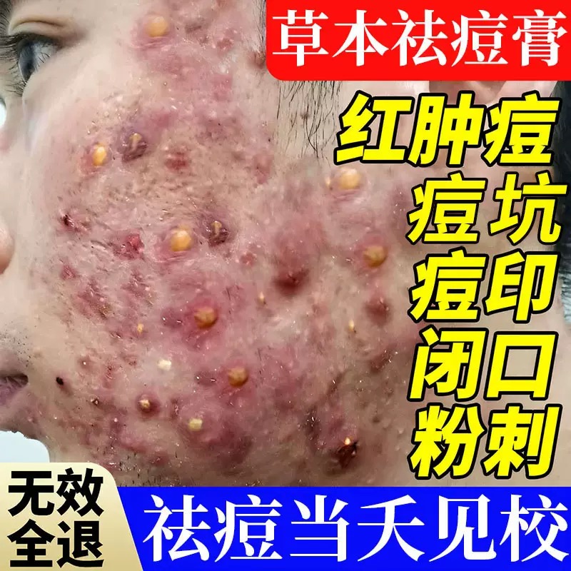 祛痘膏去痘印正品淡化修复痘坑痘疤消除闭口粉刺神器去豆豆青春痘