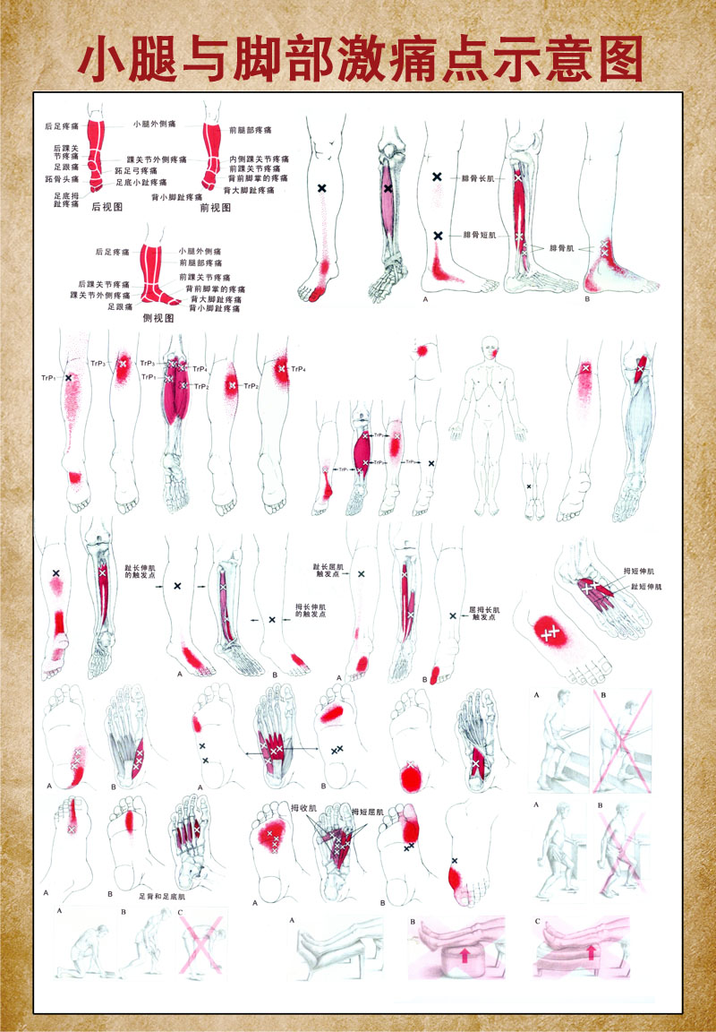 m768小腿与腿部激痛点触发点示意图1440海报印制展板写真喷绘挂图