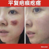 北京黑bu疤痕增生膏胸口凸起增生疙瘩胸口痤疮烫伤软化烫伤修护