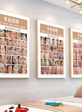 美容院装饰画斑痘敏对比图墙壁画