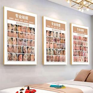 斑痘敏海报前后对比图祛痘广告美容院养生馆宣传画皮肤管理墙壁画