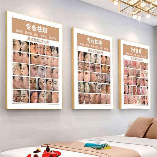 美容院装饰画斑痘敏对比图墙壁画