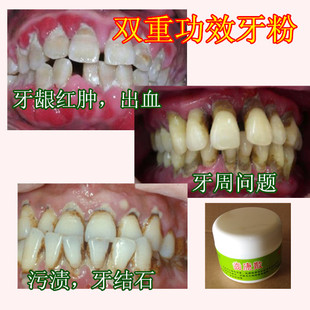 草本齿康散洗牙粉牙周牙龈口臭出血松动固齿安龈散黑牙茶烟渍包邮