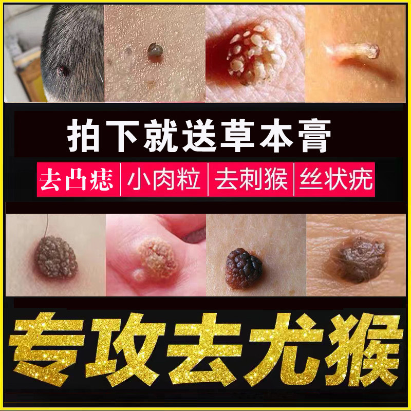 祛腋下刺瘊肉瘤皮赘去除膏猴子脖子上长的小肉粒疙瘩凸痣黑痣神器