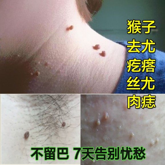 去除脖子上长小粒丝状清祛疙瘩瘊猴子一抹灵神器膏专用药
