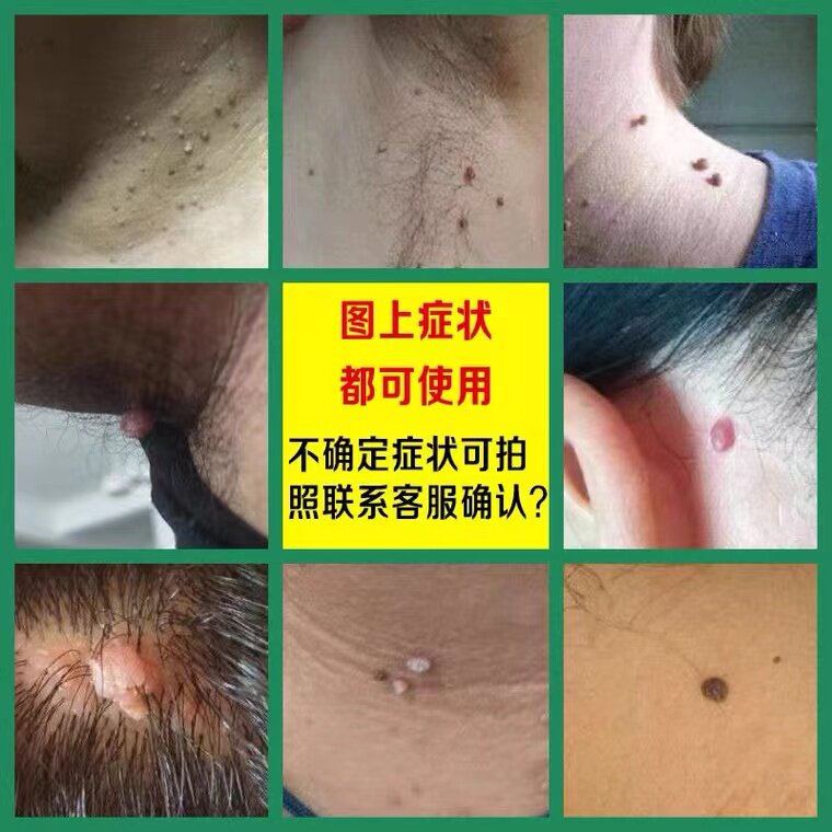 去除脖子上长小粒丝状清祛疙瘩瘊猴子一抹灵神器膏专用药