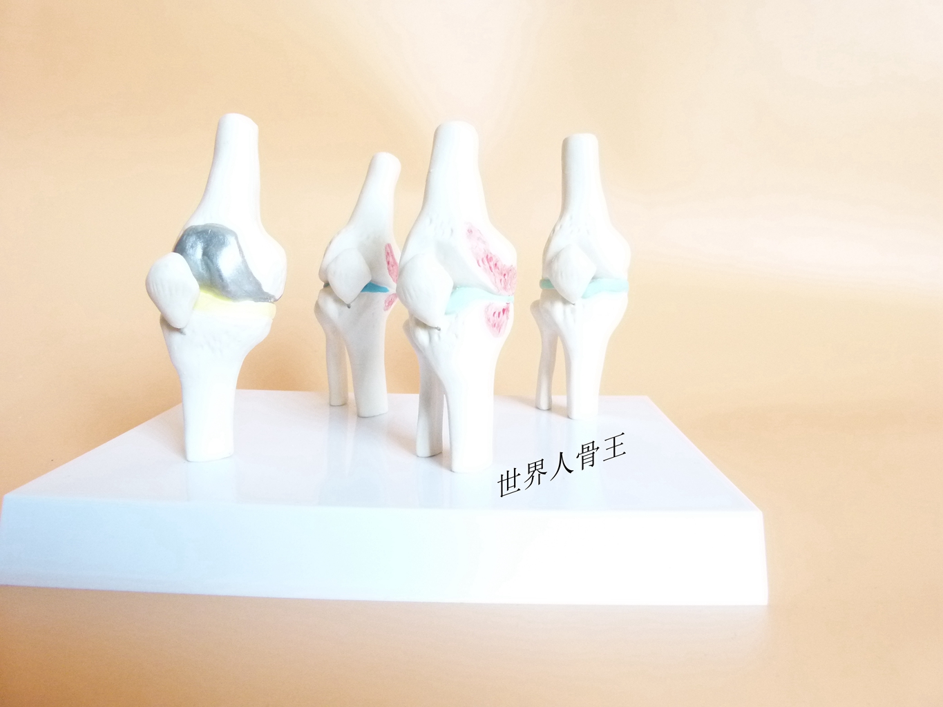 病变膝关节 2/1膝关节模型 人体关节模型四阶段病态膝关节模型